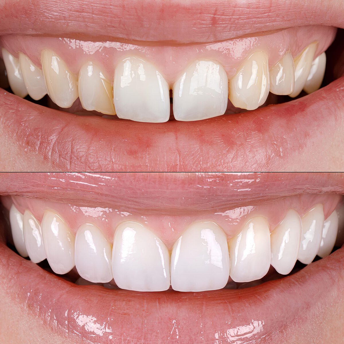 Frontzahnaesthetik-Beispiel2